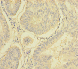 NDUFA6 Antibody - Immunohistochemistry of paraffin-embedded human endometrial cancer using NDUFA6 Antibody at dilution of 1:100