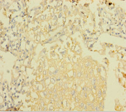NDUFA6 Antibody - Immunohistochemistry of paraffin-embedded human lung cancer using NDUFA6 Antibody at dilution of 1:100