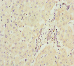 NDUFA9 Antibody - Immunohistochemistry of paraffin-embedded human liver cancer at dilution 1:100