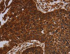 NDUFAB1 / ACP Antibody - Immunohistochemistry of paraffin-embedded Human prostate cancer using NDUFAB1 Polyclonal Antibody at dilution of 1:50.