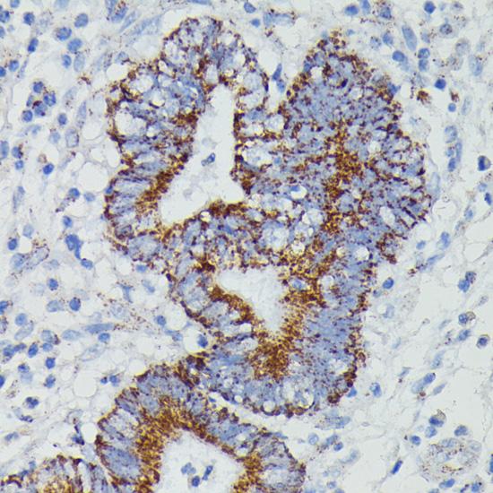 NDUFAB1 / ACP Antibody - Immunohistochemistry of paraffin-embedded Human colon carcinoma using NDUFAB1 Polyclonal Antibody at dilution of 1:100 (40x lens).