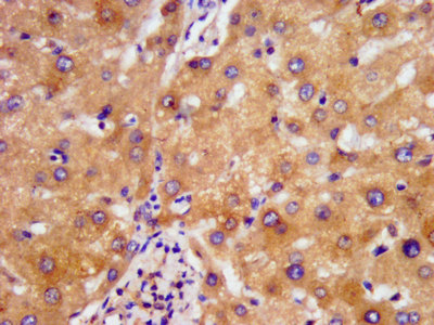NDUFAF2 / NDUFA12L Antibody - Immunohistochemistry image at a dilution of 1:500 and staining in paraffin-embedded human liver tissue performed on a Leica BondTM system. After dewaxing and hydration, antigen retrieval was mediated by high pressure in a citrate buffer (pH 6.0) . Section was blocked with 10% normal goat serum 30min at RT. Then primary antibody (1% BSA) was incubated at 4 °C overnight. The primary is detected by a biotinylated secondary antibody and visualized using an HRP conjugated SP system.