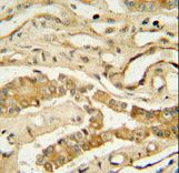 NDUFAF3 Antibody - NDUF3 antibody immunohistochemistry of formalin-fixed and paraffin-embedded human lung tissue followed by peroxidase-conjugated secondary antibody and DAB staining.