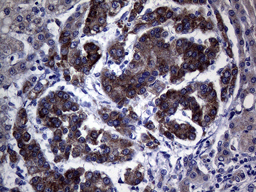 NDUFAF5 Antibody - Immunohistochemical staining of paraffin-embedded Carcinoma of Human liver tissue using anti-NDUFAF5 mouse monoclonal antibody. (Heat-induced epitope retrieval by 1mM EDTA in 10mM Tris buffer. (pH8.5) at 120°C for 3 min. (1:2000)