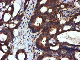 NDUFAF7 Antibody - IHC of paraffin-embedded Adenocarcinoma of Human colon tissue using anti-C2orf56 mouse monoclonal antibody.