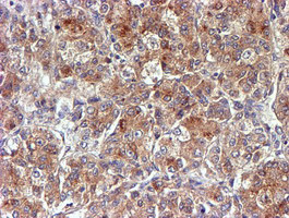 NDUFAF7 Antibody - IHC of paraffin-embedded Carcinoma of Human liver tissue using anti-C2orf56 mouse monoclonal antibody.