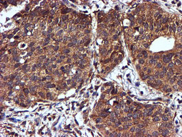 NDUFAF7 Antibody - IHC of paraffin-embedded Carcinoma of Human lung tissue using anti-C2orf56 mouse monoclonal antibody.