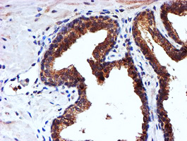 NDUFAF7 Antibody - IHC of paraffin-embedded Carcinoma of Human prostate tissue using anti-C2orf56 mouse monoclonal antibody.
