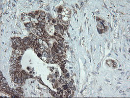 NDUFB10 Antibody - IHC of paraffin-embedded Adenocarcinoma of Human colon tissue using anti-NDUFB10 mouse monoclonal antibody.