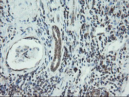 NDUFB10 Antibody - IHC of paraffin-embedded Carcinoma of Human kidney tissue using anti-NDUFB10 mouse monoclonal antibody.