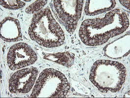NDUFB10 Antibody - IHC of paraffin-embedded Carcinoma of Human prostate tissue using anti-NDUFB10 mouse monoclonal antibody.