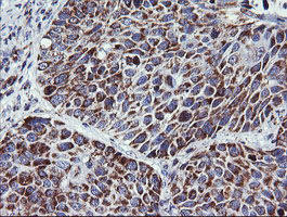 NDUFB10 Antibody - IHC of paraffin-embedded Carcinoma of Human lung tissue using anti-NDUFB10 mouse monoclonal antibody. (Heat-induced epitope retrieval by 10mM citric buffer, pH6.0, 120°C for 3min).