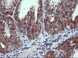 NDUFB10 Antibody - IHC of paraffin-embedded Adenocarcinoma of Human ovary tissue using anti-NDUFB10 mouse monoclonal antibody. (Heat-induced epitope retrieval by 10mM citric buffer, pH6.0, 120°C for 3min).