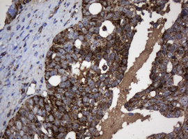 NDUFB10 Antibody - IHC of paraffin-embedded Adenocarcinoma of Human ovary tissue using anti-NDUFB10 mouse monoclonal antibody.