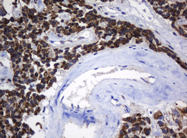 NDUFB10 Antibody - IHC of paraffin-embedded Carcinoma of Human pancreas tissue using anti-NDUFB10 mouse monoclonal antibody.