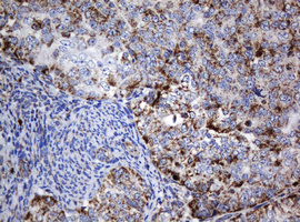 NDUFB10 Antibody - IHC of paraffin-embedded Adenocarcinoma of Human endometrium tissue using anti-NDUFB10 mouse monoclonal antibody.