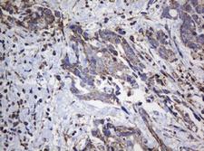 NDUFB10 Antibody - IHC of paraffin-embedded Adenocarcinoma of Human breast tissue using anti-NDUFB10 mouse monoclonal antibody.