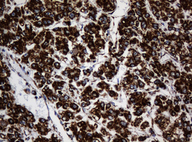 NDUFB10 Antibody - IHC of paraffin-embedded Carcinoma of Human liver tissue using anti-NDUFB10 mouse monoclonal antibody.