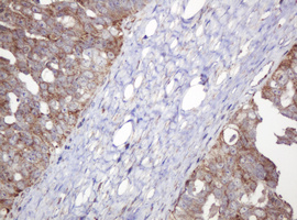 NDUFB10 Antibody - IHC of paraffin-embedded Adenocarcinoma of Human ovary tissue using anti-NDUFB10 mouse monoclonal antibody.
