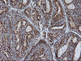 NDUFB10 Antibody - IHC of paraffin-embedded Carcinoma of Human thyroid tissue using anti-NDUFB10 mouse monoclonal antibody.