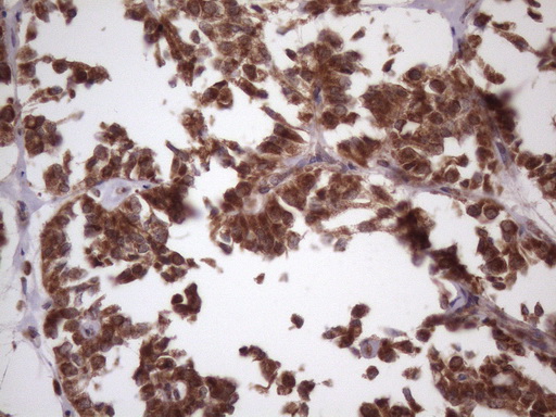 NDUFB11 Antibody - Immunohistochemical staining of paraffin-embedded Carcinoma of Human pancreas tissue using anti-NDUFB11 mouse monoclonal antibody. (Heat-induced epitope retrieval by 1 mM EDTA in 10mM Tris, pH8.5, 120C for 3min. (1:150)