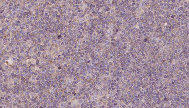 NDUFB11 Antibody - 1:100 staining human lymph carcinoma tissue by IHC-P. The sample was formaldehyde fixed and a heat mediated antigen retrieval step in citrate buffer was performed. The sample was then blocked and incubated with the antibody for 1.5 hours at 22°C. An HRP conjugated goat anti-rabbit antibody was used as the secondary.
