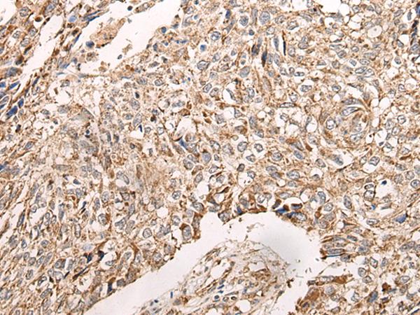 NDUFB11 Antibody - Immunohistochemistry of paraffin-embedded Human lung cancer tissue  using NDUFB11 Polyclonal Antibody at dilution of 1:95(×200)
