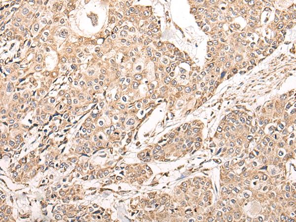 NDUFB11 Antibody - Immunohistochemistry of paraffin-embedded Human prost ate cancer tissue  using NDUFB11 Polyclonal Antibody at dilution of 1:95(×200)