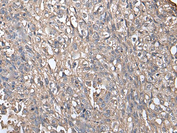 NDUFB5 Antibody - Immunohistochemistry of paraffin-embedded Human lung cancer tissue  using NDUFB5 Polyclonal Antibody at dilution of 1:45(×200)
