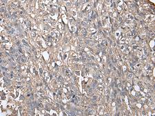 NDUFB5 Antibody - Immunohistochemistry of paraffin-embedded Human lung cancer tissue  using NDUFB5 Polyclonal Antibody at dilution of 1:45(×200)
