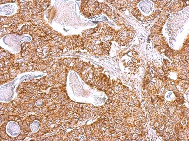 NDUFB9 Antibody - NDUFB9 antibody detects NDUFB9 protein at cytosol on gastric carcinoma by immunohistochemical analysis. Sample: Paraffin-embedded gastric carcinoma. NDUFB9 antibody dilution:1:500.