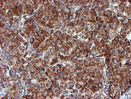 NDUFB9 Antibody - IHC of paraffin-embedded Carcinoma of Human liver tissue using anti-NDUFB9 mouse monoclonal antibody.