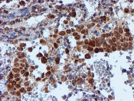 NDUFB9 Antibody - IHC of paraffin-embedded Carcinoma of Human lung tissue using anti-NDUFB9 mouse monoclonal antibody.