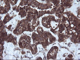 NDUFB9 Antibody - IHC of paraffin-embedded Adenocarcinoma of Human ovary tissue using anti-NDUFB9 mouse monoclonal antibody.