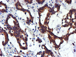 NDUFB9 Antibody - IHC of paraffin-embedded Adenocarcinoma of Human colon tissue using anti-NDUFB9 mouse monoclonal antibody.