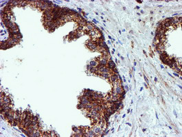 NDUFB9 Antibody - IHC of paraffin-embedded Carcinoma of Human prostate tissue using anti-NDUFB9 mouse monoclonal antibody.
