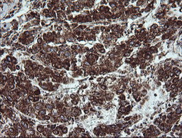 NDUFB9 Antibody - IHC of paraffin-embedded Carcinoma of Human liver tissue using anti-NDUFB9 mouse monoclonal antibody.