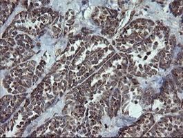 NDUFB9 Antibody - IHC of paraffin-embedded Carcinoma of Human thyroid tissue using anti-NDUFB9 mouse monoclonal antibody.