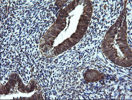 NDUFB9 Antibody - IHC of paraffin-embedded Adenocarcinoma of Human endometrium tissue using anti-NDUFB9 mouse monoclonal antibody.