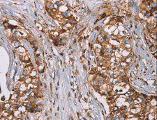 NDUFS1 Antibody - Immunohistochemistry of paraffin-embedded Human breast cancer using NDUFS1 Polyclonal Antibody at dilution of 1:50.