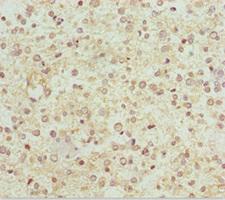 NDUFS1 Antibody - Immunohistochemistry of paraffin-embedded human glioma cancer at dilution 1:100