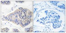 NDUFS1 Antibody - Peptide - + Immunohistochemistry analysis of paraffin-embedded human breast carcinoma tissue, using NDUFS1 antibody.