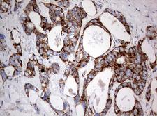 NDUFS2 Antibody - IHC of paraffin-embedded Adenocarcinoma of Human colon tissue using anti-NDUFS2 mouse monoclonal antibody. (Heat-induced epitope retrieval by 10mM citric buffer, pH6.0, 120°C for 3min).