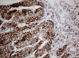 NDUFS2 Antibody - IHC of paraffin-embedded Carcinoma of Human liver tissue using anti-NDUFS2 mouse monoclonal antibody. (Heat-induced epitope retrieval by 10mM citric buffer, pH6.0, 120°C for 3min).