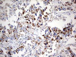 NDUFS2 Antibody - IHC of paraffin-embedded Adenocarcinoma of Human ovary tissue using anti-NDUFS2 mouse monoclonal antibody. (Heat-induced epitope retrieval by 10mM citric buffer, pH6.0, 120°C for 3min).