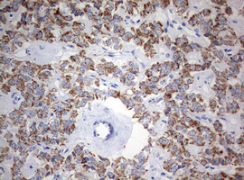 NDUFS2 Antibody - IHC of paraffin-embedded Carcinoma of Human pancreas tissue using anti-NDUFS2 mouse monoclonal antibody. (Heat-induced epitope retrieval by 10mM citric buffer, pH6.0, 120°C for 3min).
