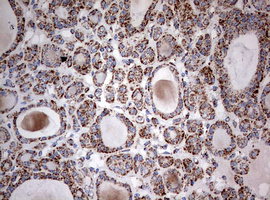 NDUFS2 Antibody - IHC of paraffin-embedded Carcinoma of Human thyroid tissue using anti-NDUFS2 mouse monoclonal antibody. (Heat-induced epitope retrieval by 10mM citric buffer, pH6.0, 120°C for 3min).