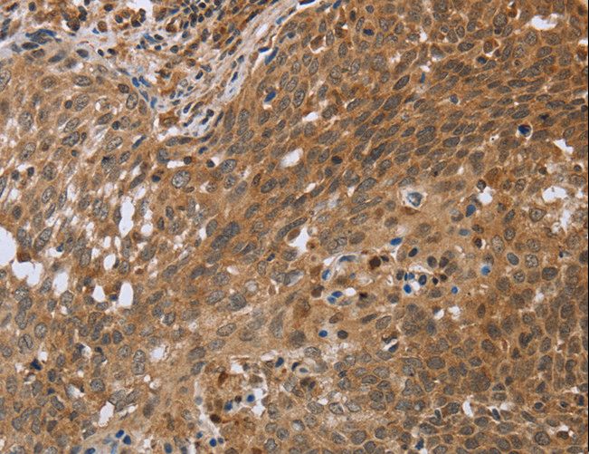NDUFS2 Antibody - Immunohistochemistry of paraffin-embedded Human cervical cancer using NDUFS2 Polyclonal Antibody at dilution of 1:35.
