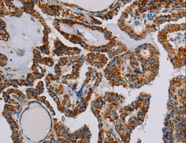 NDUFS3 Antibody - Immunohistochemistry of paraffin-embedded Human thyroid cancer using NDUFS3 Polyclonal Antibody at dilution of 1:30.