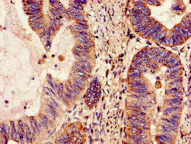 NDUFS4 Antibody - Immunohistochemistry image of paraffin-embedded human colon cancer at a dilution of 1:100